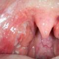 Qué hacer si se encuentra estafilococo en la garganta de un niño Tratamiento de la infección por estafilococo en la garganta en niños